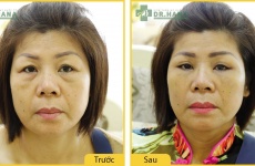 Cảm nhận của khách hàng Trịnh Thị Thu sau khi xóa bọng mỡ mắt tại Dr.Hana