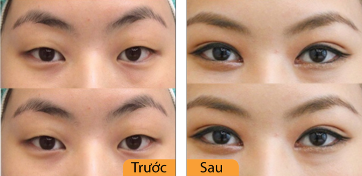 Hình ảnh khách hàng sau khi tạo hình mắt 2 mí tại Dr.Hana