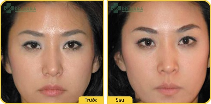 Hình ảnh khách hàng trước và sau thực hiện treo mí mắt sụp